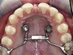 Mini Screw Assisted Treatment - Thumbnail 1
