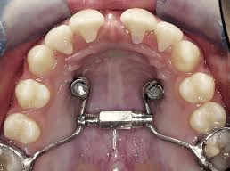 Mini Screw Assisted Treatment