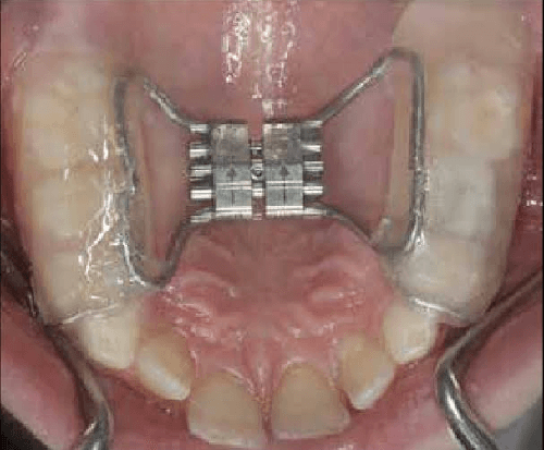 Rapid Maxillary Expansion - Main View