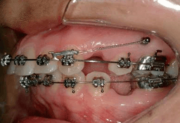 Mini Screw Assisted Treatment - Thumbnail 3