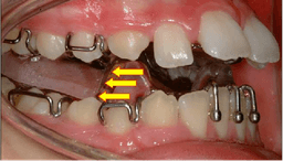 Myofunctional Treatment - Thumbnail 2