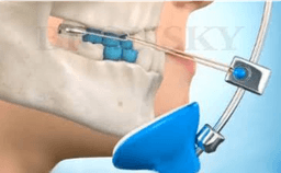 Myofunctional Treatment - Thumbnail 4