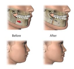 Orthognathic Surgery - Thumbnail 1