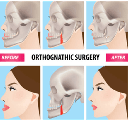 Orthognathic Surgery - Thumbnail 2