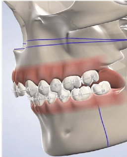 Orthognathic Surgery - Thumbnail 3