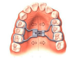 Rapid Maxillary Expansion - Thumbnail 2