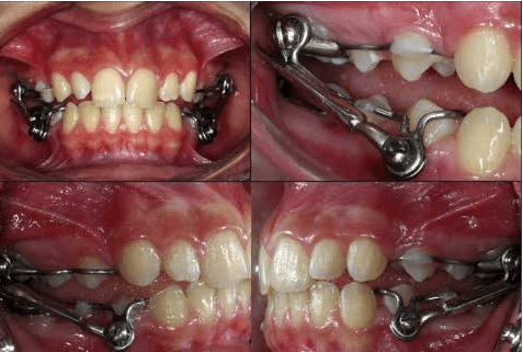 Fixed Functional Appliances