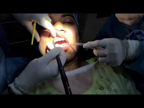 Teeth Alignment