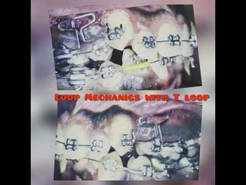 Orthodontic Treatment Process