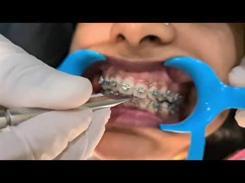 Orthodontic Consultation